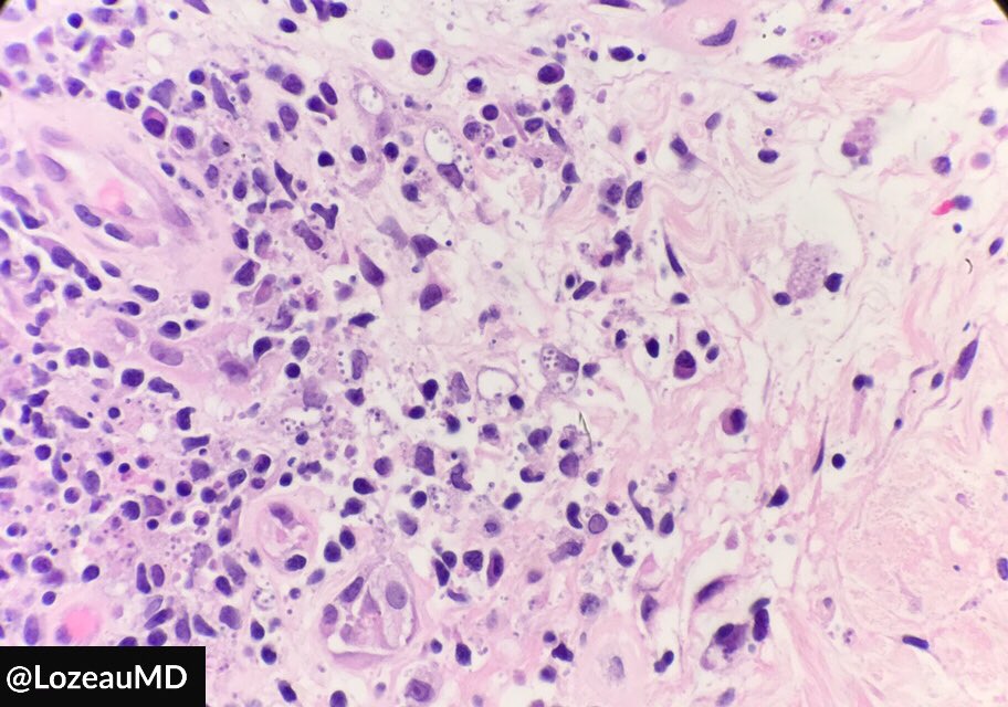 LozeauMD's tweet photo. Skin lesions following bug bites while visiting a tropical place. Cutaneous Leishmaniasis! I’m usually a low power person, but sometimes “I ❤️ HIGH POWER.” #ASDP18 #dermpath #pathology #dermatology https://t.co/S1lpIsvs5N