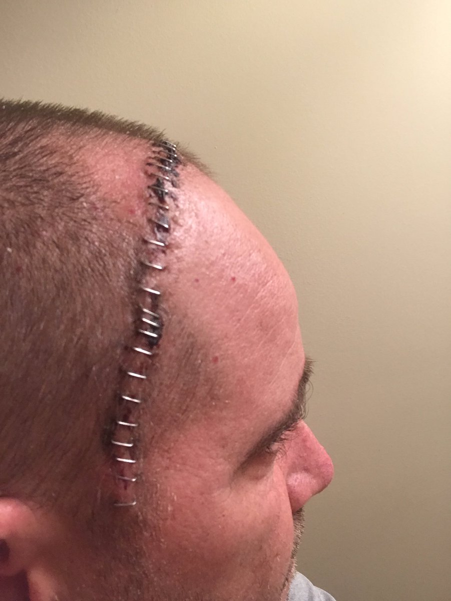 QuakesPrime's tweet photo. Scars from surgery! A little hard to look at, but a reminder I’ve been given the gift to life.I want to give my sincere thanks to Top Gun Academy, Iowa Premier, @GretnaSoftball, @KCZephyrsRW @CrusadersSball. Your support and prayers helped me get through it! https://t.co/LjDuQPc1tD