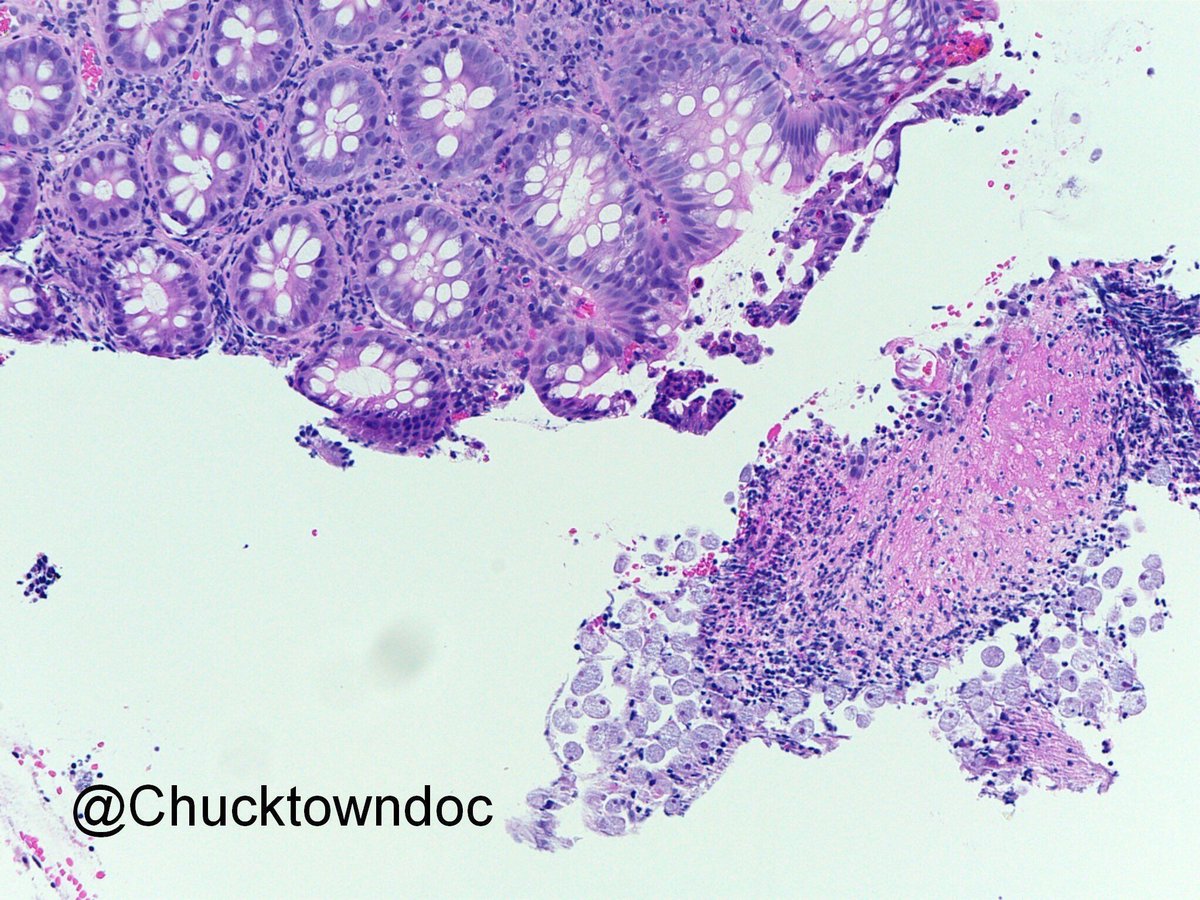 JMGardnerMD's tweet image. Entamoeba in colon biopsy. Amoeba remind me of big odd histiocytes. Amazing pics by @chucktowndoc. #Pathology #GIpath #IDpath