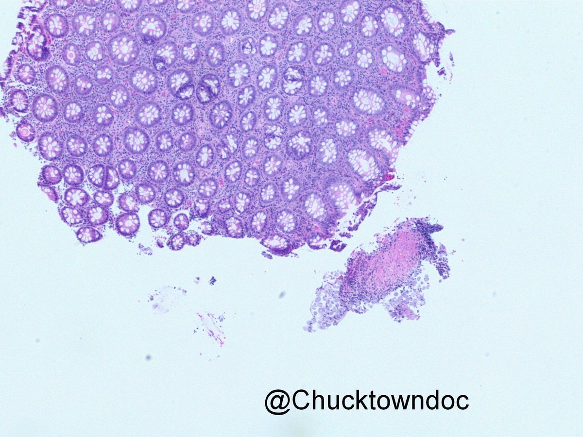 JMGardnerMD's tweet image. Entamoeba in colon biopsy. Amoeba remind me of big odd histiocytes. Amazing pics by @chucktowndoc. #Pathology #GIpath #IDpath