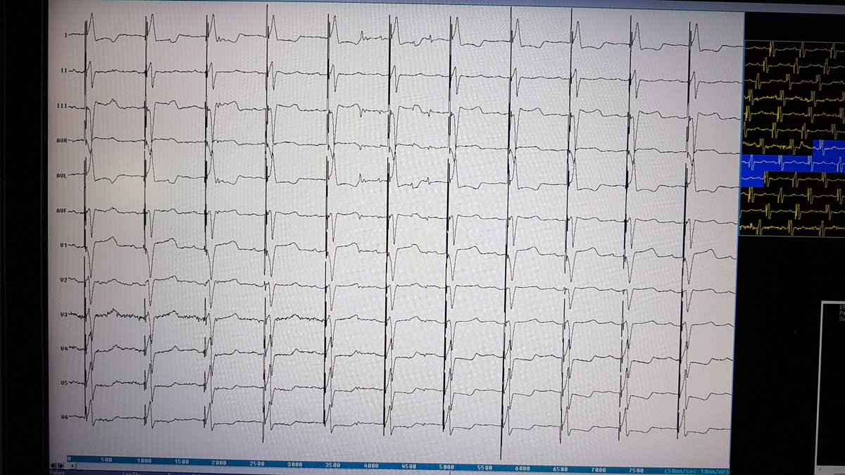 60th case of HBP. Very low threshold  (0.4V x 1.0ms). when we see great potential of his of right side with mapping catheter, the implant seems easier. <a href="/Davilandre/">Andre d’Avila</a> #dontdisthehis