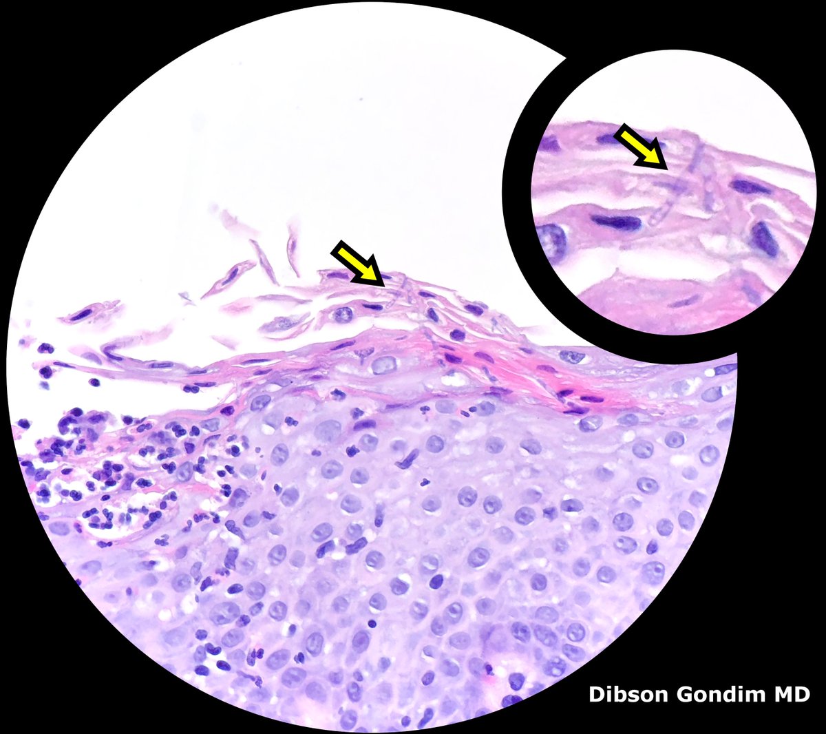 DibsonG's tweet image. Candida esophagitis - parakeratosis+superficial neutrophils+pseudohyphae (arrows) within viable epithelium. #GIpath