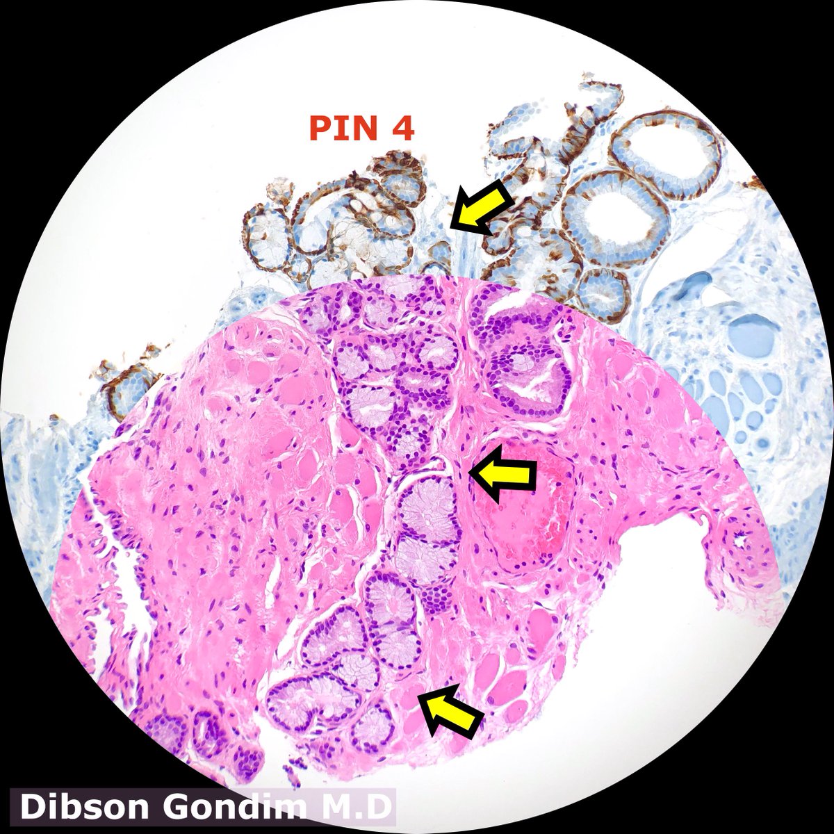 DibsonG's tweet image. Cowper&apos;s glands(arrows) on prostate needle biopsy, note skeletal muscle at periphery. Very rare finding!!! 0.006% in a series (Cina, Epstein et Al. goo.gl/ZbJE5o) @JMGardnerMD @smlungpathguy @rovingatuscap @Williamson_SR @AnapathResident @kriyer68 @EPDavaro #GUpath