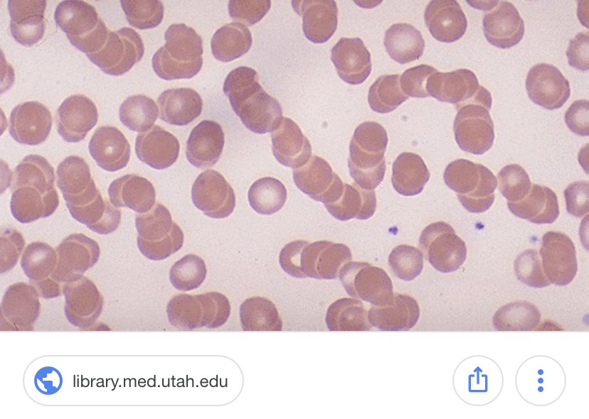 prep4USMLE's tweet photo. Rouleaux formation - alignment of RBCs in stack, maybe due to paraproteinemias such as MM, macroglobulinemia) or artifactual. #Usmle #Hematology https://t.co/uKqLYDHfKC