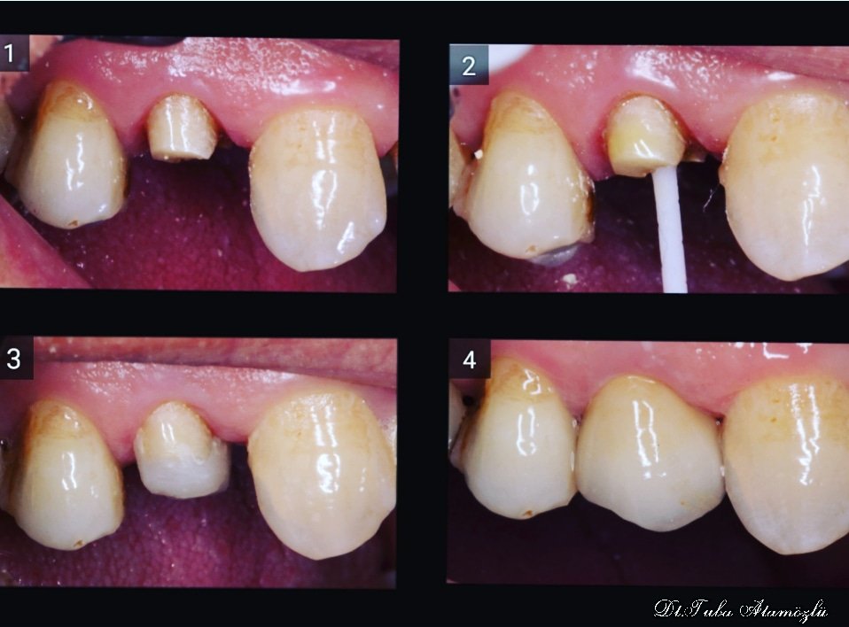 softdentubakerm's tweet image. #Fiberpost uygulaması ile madde kaybı çok olan dişleri önce güçlendiriyoruz. Sonra kaplamasını (#kron) yapıyoruz.