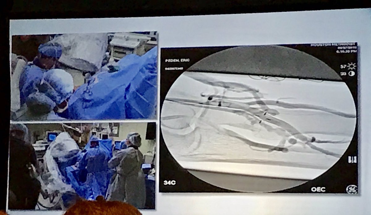 wasse_m's tweet photo. Dr. Eric Peden takes us through a video case using the WaveLinQ endo-AVF system at #CIDA2018 @ASDINNews #dialysisaccess #innovation @Dialysis_Access https://t.co/Zq99zOiZVt