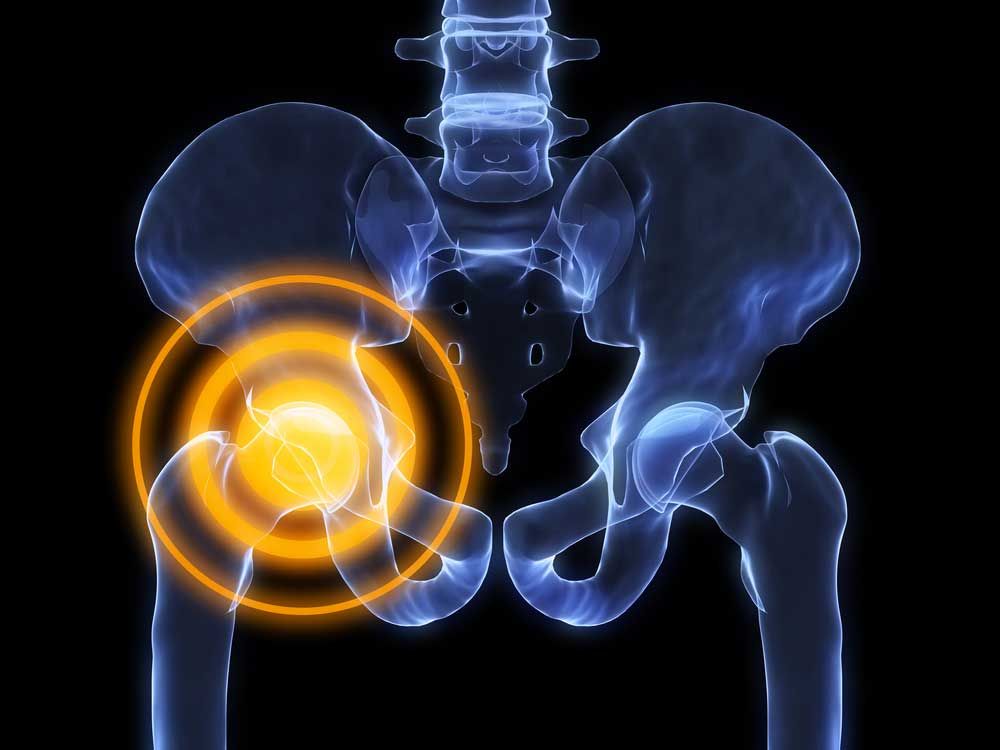 Femoroacetabular impingement (#FAI) is a major contributing cause of early degenerative joint disease of the #hip in young, active patients. FAI often causes damage to #articularcartilage, and can also cause a separation or tear of the #labral #cartilage. medilink.us/ew0x