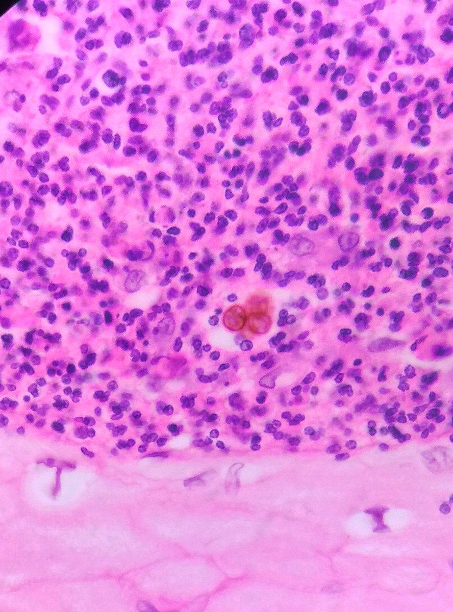 Pankaj kumar (@bsc_pankaj) on Twitter photo Copper pennies/Medler bodies. <a href="/drsps2k6/">Praveen Sharma</a> <a href="/smlungpathguy/">Sanjay Mukhopadhyay</a> <a href="/kriyer68/">Kalyani Bambal</a> #infectivepathology Copper pennies/Medler bodies. <a href="/drsps2k6/">Praveen Sharma</a> <a href="/smlungpathguy/">Sanjay Mukhopadhyay</a> <a href="/kriyer68/">Kalyani Bambal</a> #infectivepathology