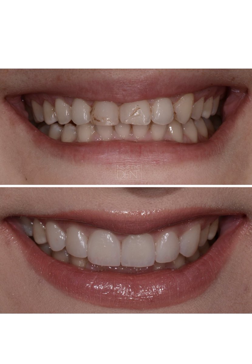 6 emax laminates:) very thin, harmless, natural✨