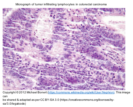 BiomedRevon's tweet photo. New target to counter #tumor immune evasion: Siglec[#sialicacid-binding Ig-like #lectin]-9 on CD8+ #Tcells interacts w/#tumorcells' #sialoglycan self-antigens, blunting antitumor response. Both are increased in #lungcancer/#ovariancancer/#colorectalcancer. https://t.co/TLtNdEKvxA https://t.co/fdHTGqhXaM