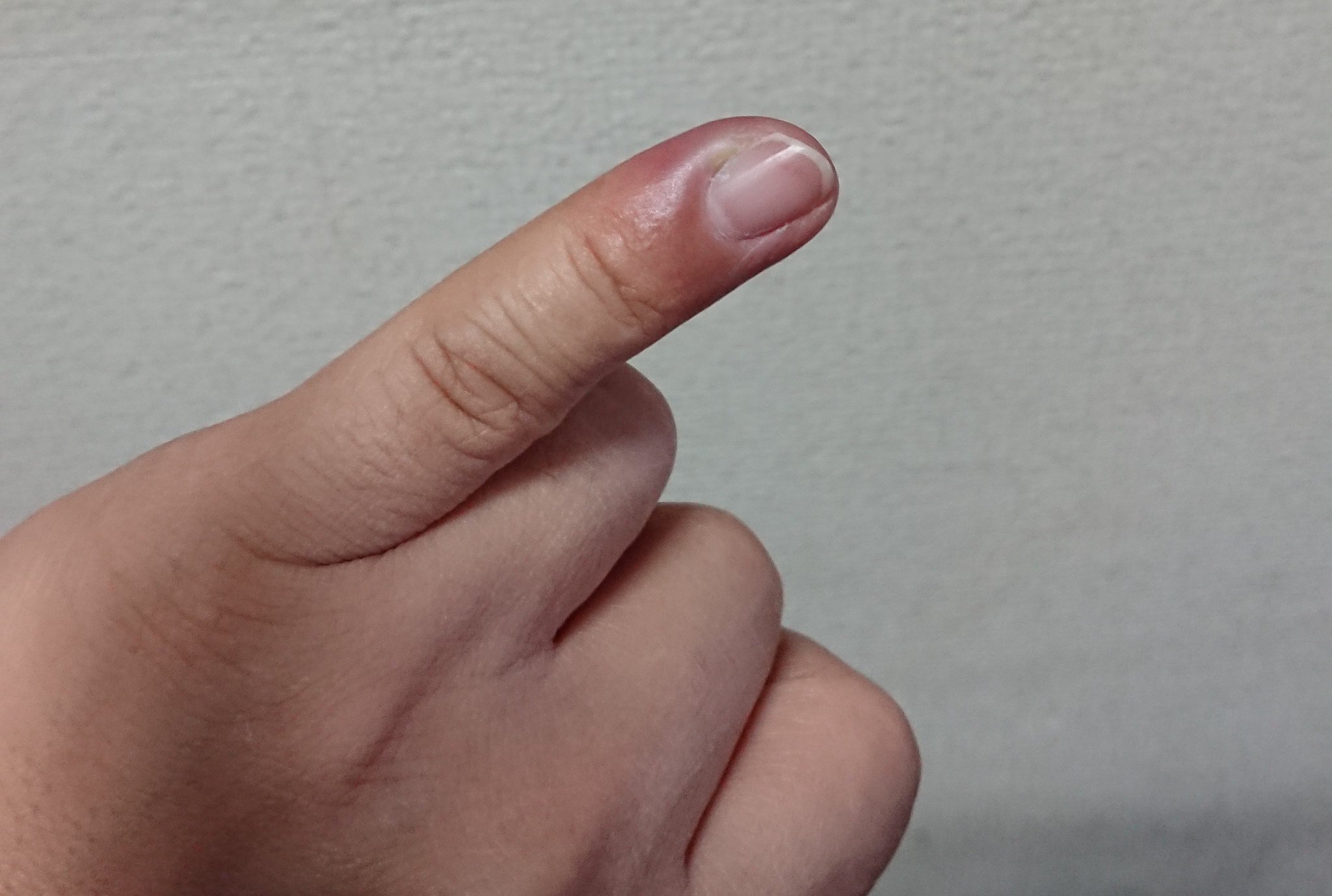 ジェイソン 小指の先が腫れて痛いんだけど何これ ぶつけたとか挟んだ事も無い 思い当たるのは軽いささくれみたいなのがある時にちょっと汚れた水いじった事くらい そんなんでバイ菌とか入るの 別に血とかも出てなかったんだけど T Co E0h9tmf1xj