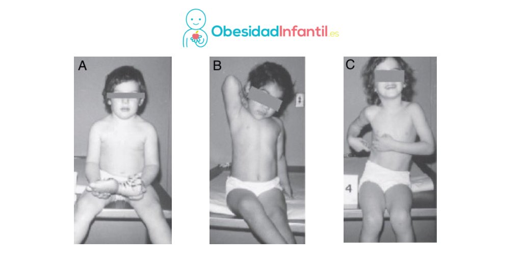 ObesidadInf_ESP's tweet photo. 🚨 ¿Eres #madre, #padre o trabajas con #niños y #adolescentes?
🌟¡Te necesitamos para una encuesta!🌟
En la ilustración se observan a 3 niñas distintas (A, B, y C)
🔵¿Cuál tiene un #peso saludable?
Puedes responder en el #Hilo ⬇️
Se agradecen los RT y las respuestas 
¡GRACIAS! ❤️ https://t.co/NjwCq1jBix