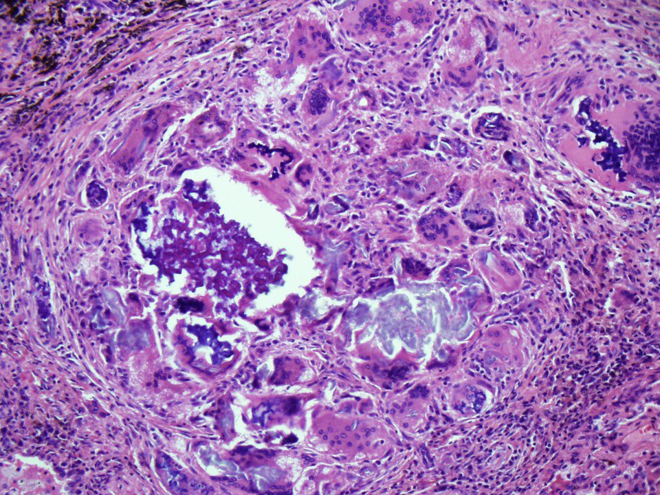 2/In MOST cases of organizing pneumonia seen on lung biopsy, the etiology is not evident on histology. But sometimes, there is a clue. Examine this pic closely and then see if you can answer the quiz in the next tweet in this thread.