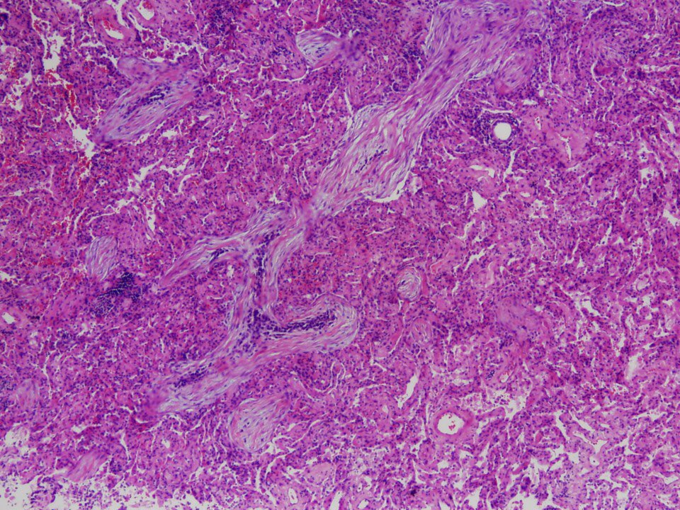 1/This is the beginning of a  #tweetorial or  #pathtweetorial on a mystery topic. Fear not, it’ll become evident soon what we’re talking about. But first I’ll show you an image. These serpiginous fibroblast plugs are diagnostic if organizing pneumonia (formerly BOOP)