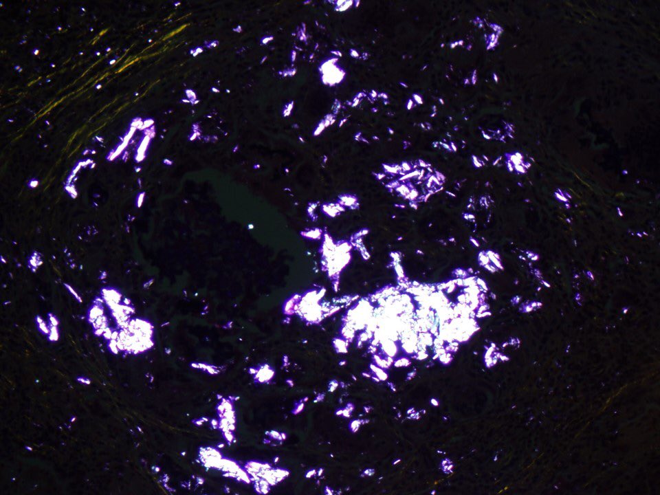 4/ Before I reveal the answer, let me show you what happened when I looked at the same field under polarized light. The particles at bottom right were birefringent but not the ones at top left. Do you know why?  #pathology  #pulmpath