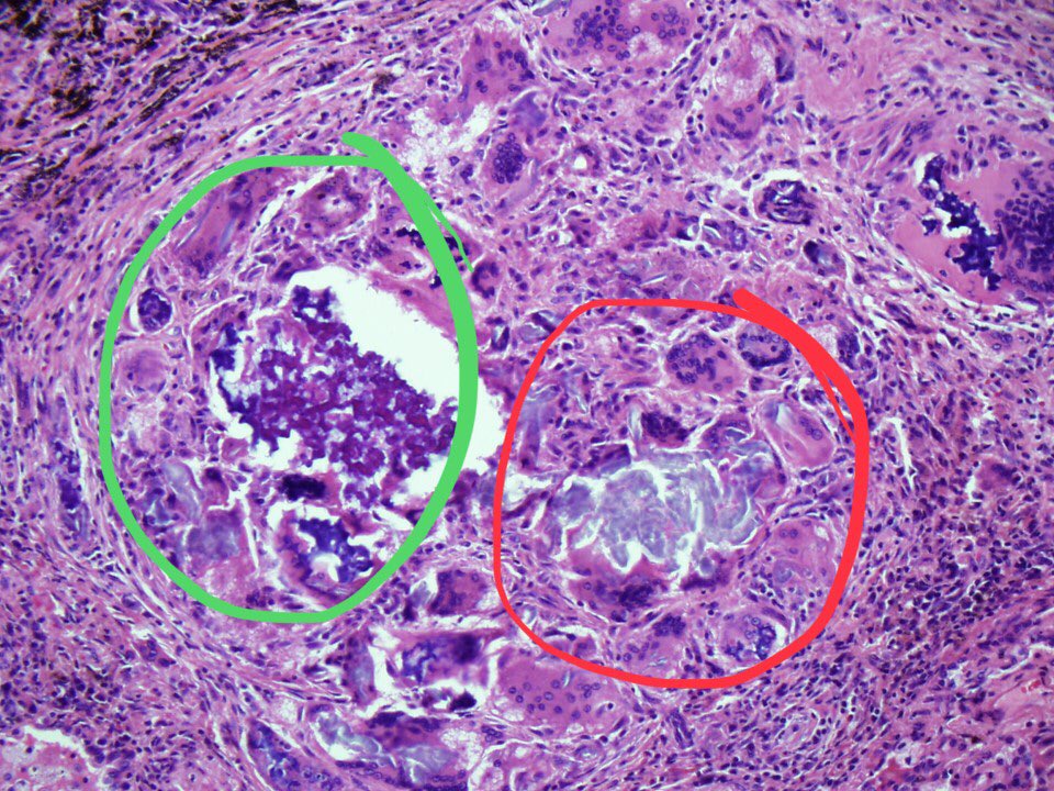 5/ It’s because there are 2 types of pill fillers (excipients) in this image. Microcrystalline cellulose (red circle) and crospovidone (green circle). The former is colorless and brightly birefringent. The latter is purple but not birefringent. Both provide bulk to oral pills.