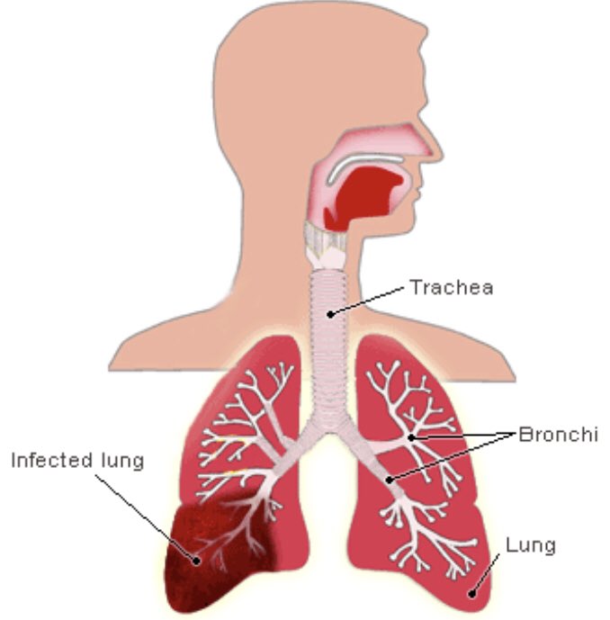 8/This is NOT the aspiration pneumonia you learn about in medical school or as a pulmonologist or ID doc. These are not debilitated patients with GERD and a dilated esophagus, right lower lobe infiltrates and aspiration of oral flora into the lung. This is different...