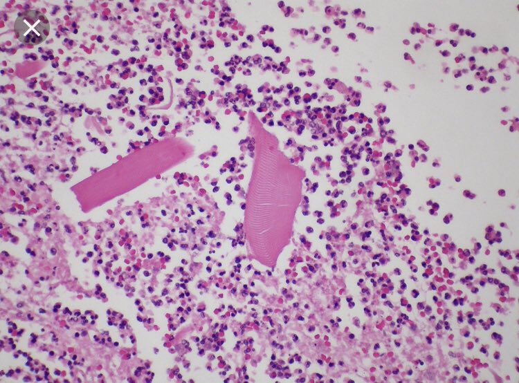 10/What are these aspirated particles that can show up in lung biopsies? 1. Vegetable particles 2. Meat particles (rare)3. Pill fillers (rare)4. Kayexalate (rare)Meat (skeletal muscle) can be seen at autopsy but gets rapidly destroyed so is seldom seen in biopsies.