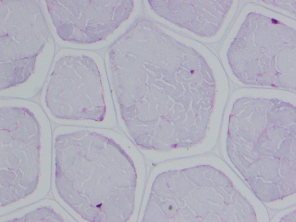 13/ And the pathology gets REALLY weird. It deviates from what you expect to see in aspiration pneumonia. You expect to see INTACT food particles WITHIN bronchi or bronchioles associated with acute inflammation, right? A bit like this? (that’s potato, by the way)