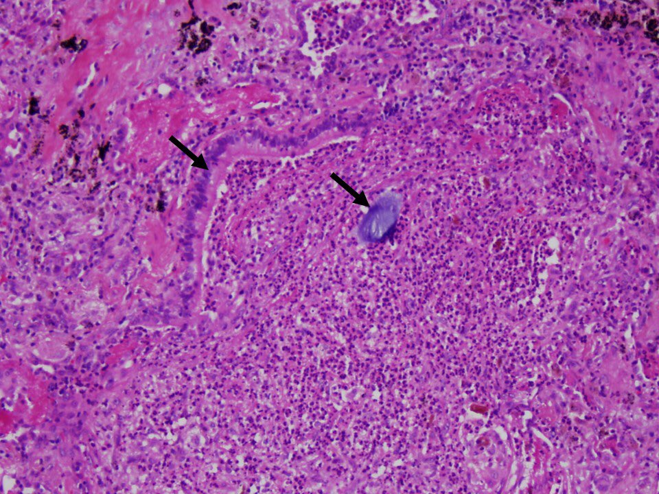 13/ And the pathology gets REALLY weird. It deviates from what you expect to see in aspiration pneumonia. You expect to see INTACT food particles WITHIN bronchi or bronchioles associated with acute inflammation, right? A bit like this? (that’s potato, by the way)