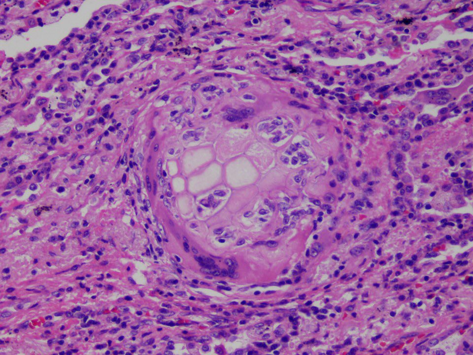 15/ In lung biopsies with particulate matter aspiration, you will see intact and degenerated vegetable particles ANYWHERE in the parenchyma, not necessarily in a lumen. There is usually a giant cell around the material, and organizing pneumonia is common.