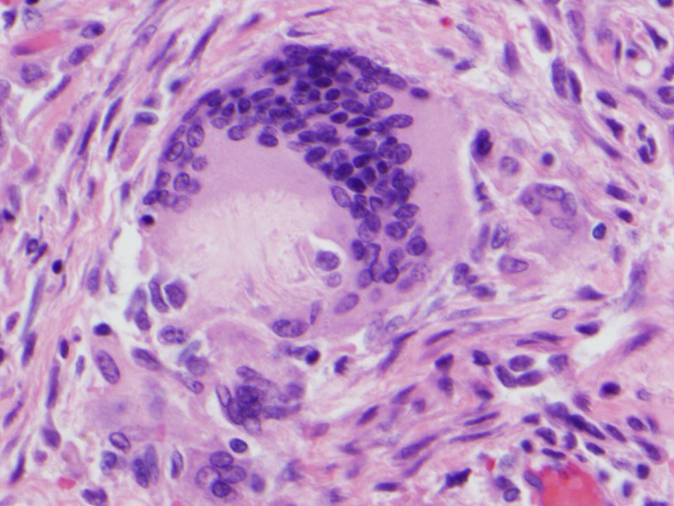 15/ In lung biopsies with particulate matter aspiration, you will see intact and degenerated vegetable particles ANYWHERE in the parenchyma, not necessarily in a lumen. There is usually a giant cell around the material, and organizing pneumonia is common.