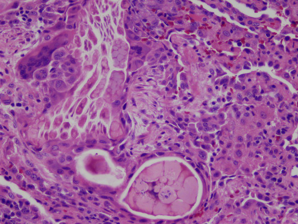 18/One of the most classic aspirated particles in this disease is the so-called “lentil”. It’s essentially a legume, which for some reason is aspirated a LOT and survives in the lung. First pic is a navy bean I embedded. Others are examples of lentil aspiration.