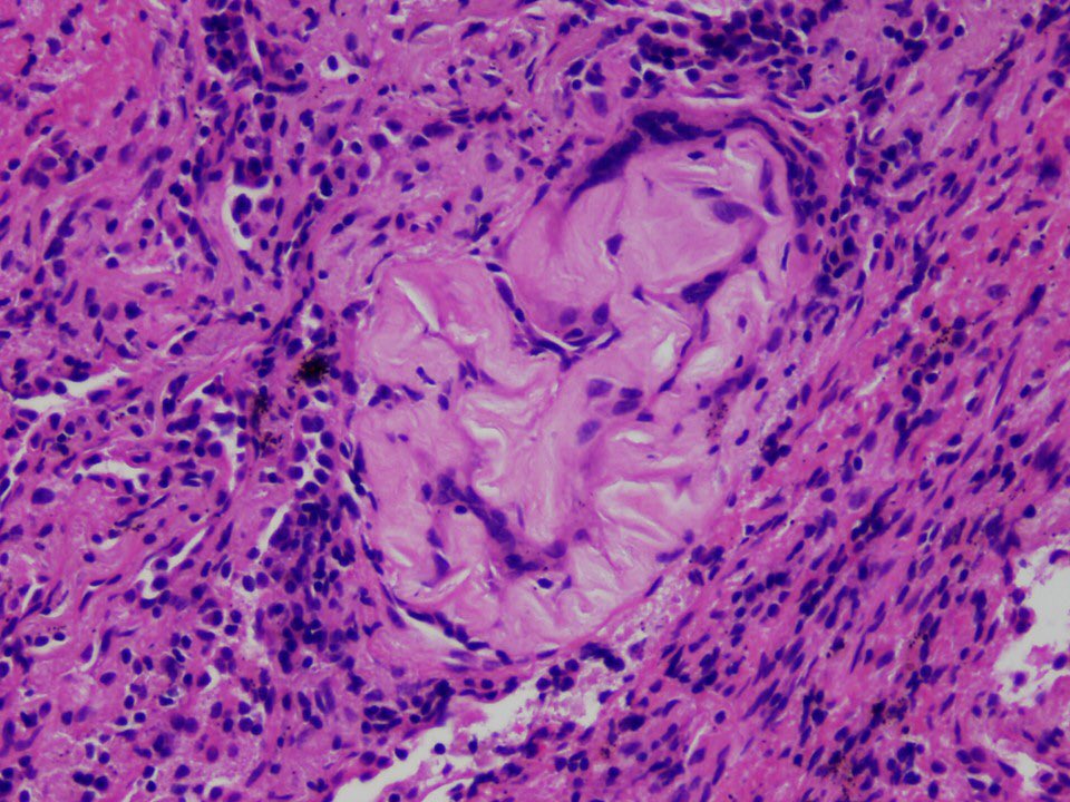 21/And finally, you should try to learn to recognize food particles even when they’ve undergone advanced degeneration. This can be the key to making a specific diagnosis of particulate matter aspiration.