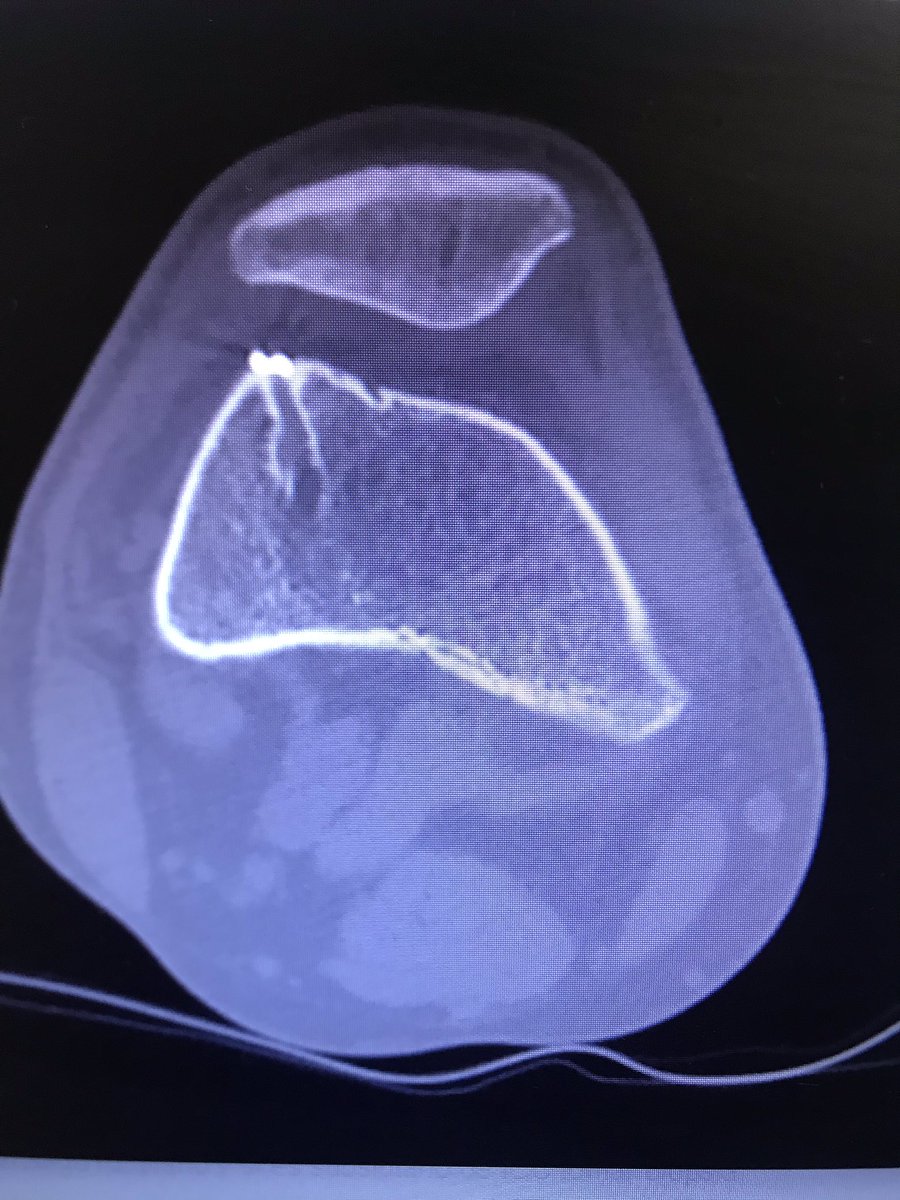DraIsaGuillen's tweet photo. Paciente con #inestabilidad anterior de rodilla posterior a ligamentoplatia. En el estudio de tac se observa dispositivo #endobutton intraarticular y en articulación femoropatelar. El paciente no tenía síntomas. https://t.co/AXmOaFHlkP