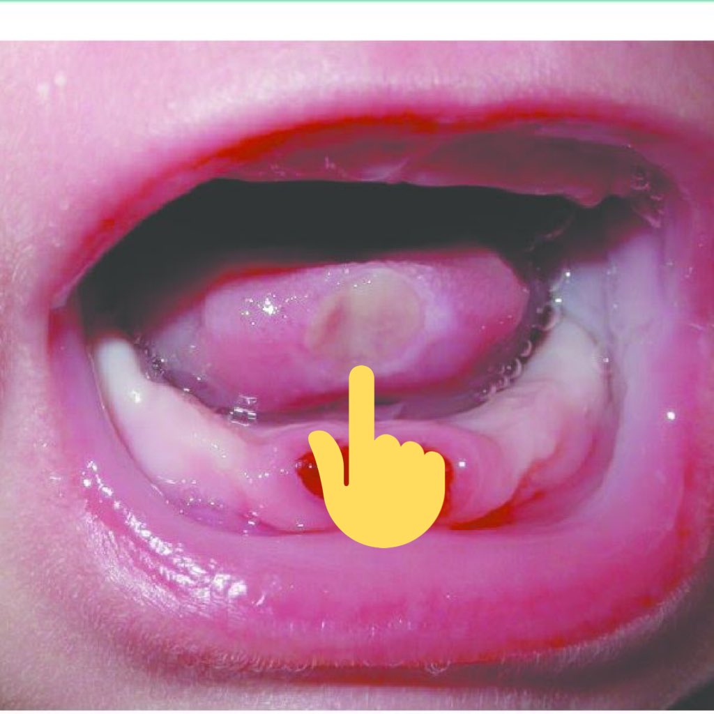 Md3ziz's tweet photo. Riga-Fede disease: is a reactive mucosal disease as a result of repetitive trauma of the tongue by the anterior primary teeth during forward and backward movement. occurs soon after birth when associated with (neo)natal teeth.
#made_easy #oralpath #PEDO https://t.co/wmBDXtFthk