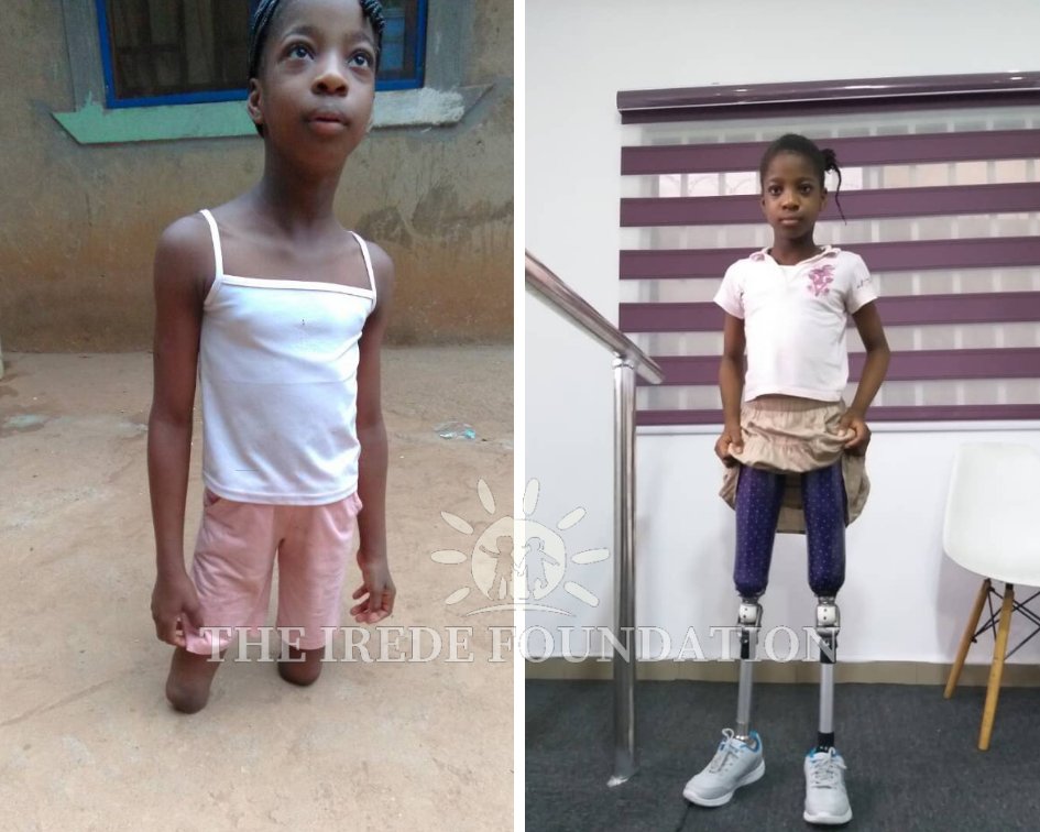 What defines us is how well we rise after falling.

#MondayMotivation #ChildAmputeeAdvocate #BuildingAnInclusiveSociety #ExtendingLimbsRaisingChampions #SDG10 #Saynotoinequality #Inclusion #LimbPossible #ChildEmpowerment #Prostheses