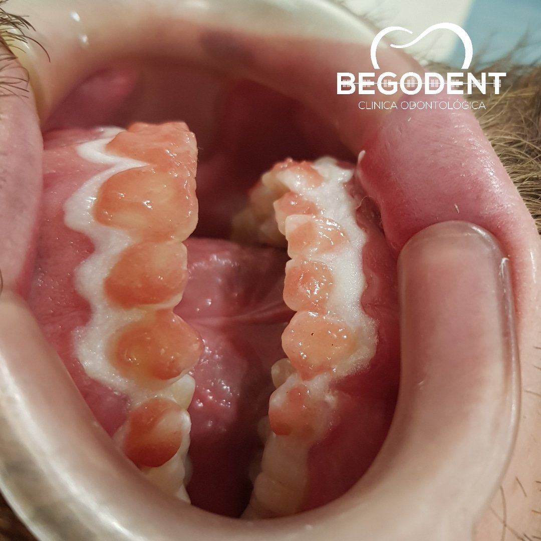 BegoDentCO's tweet photo. #BlanqueamientoDental
Es un tratamiento dental estético que logra reducir varios tonos el color original de las piezas dentales, dejando los dientes más blancos.
El blanqueamiento dental se puede realizar en consultorio o en el hogar Siempre bajo supervisión de un profesional https://t.co/Vw9YZ0krEq