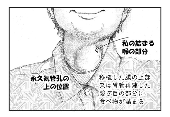 食道癌や 咽頭癌の手術を経験された方へ
「食べ物や唾液がのどに詰まる」症状を緩和する方法を、イラストと文章で説明しました。不快の思いをされている方に、役立てば良いな!
私も頑張っていますww
https://t.co/iimxBZZvN5 #嚥下障害 #はてなブログ 
