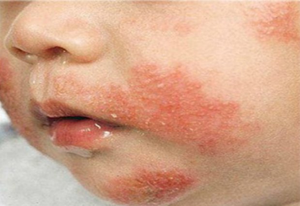 RodnikMed's tweet image. Детская экзема — распространённое кожное заболевание, диагностируемое у трети больных, обращающихся с зудящими высыпаниями. 
В нашем Роднике ведет прием аллерголог-иммунолог высшей  категории Усова Елена Михайловна. 
Приходите! Будем рады помочь!
запись по тел. 336-63-06