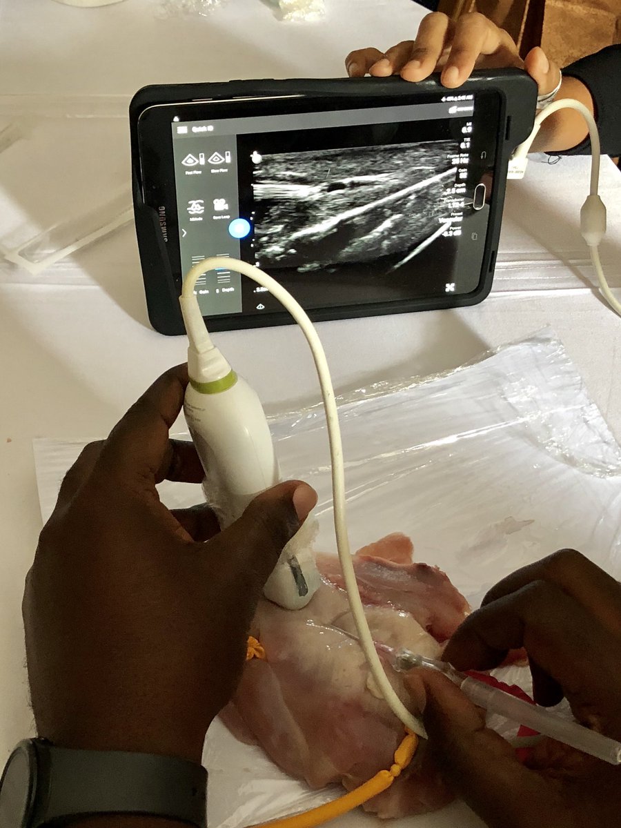 PURE (@pure_updates) on Twitter photo .#AfCEM18 #pocus learners are rocking it! All tapping the balloons on our chicken sim for vascular access & nerve blocks on the <a href="/PhilipsLumify/">Philips Lumify</a> #FOAMus <a href="/Novaleda/">NovaLeda</a> <a href="/NagdevArun/">Arun Nagdev</a> @bedsidesono <a href="/GandhiKavita42/">Kavita Gandhi</a> .#AfCEM18 #pocus learners are rocking it! All tapping the balloons on our chicken sim for vascular access & nerve blocks on the <a href="/PhilipsLumify/">Philips Lumify</a> #FOAMus <a href="/Novaleda/">NovaLeda</a> <a href="/NagdevArun/">Arun Nagdev</a> @bedsidesono <a href="/GandhiKavita42/">Kavita Gandhi</a>