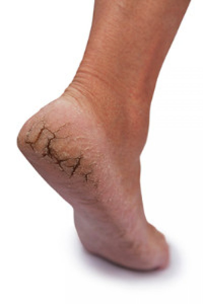 PodiatryAustin's tweet photo. What Is The Most Common Cause Of Cracked Heels? https://t.co/UCvZvGolVD https://t.co/46mmCHY1hr