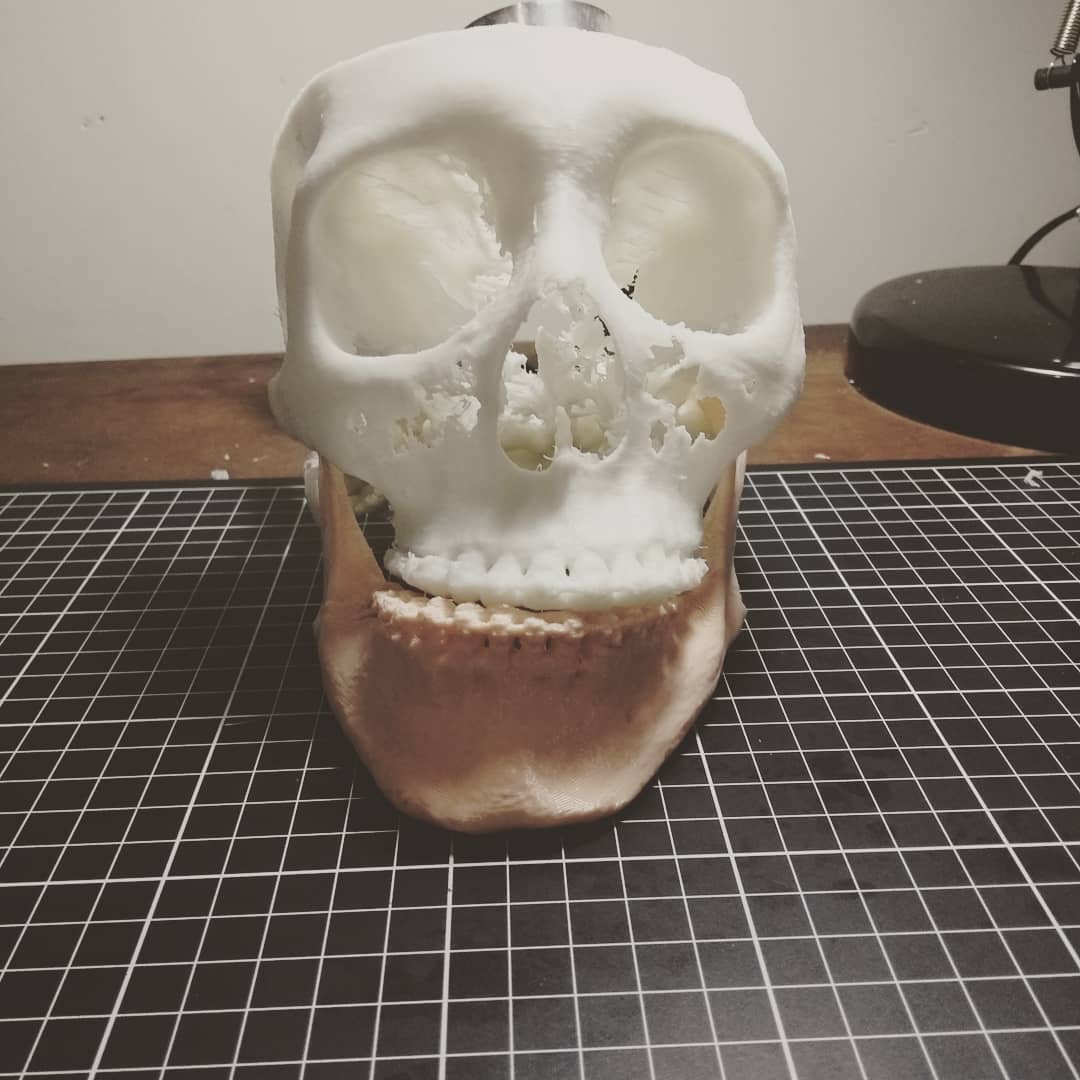 3D surface rendering and 3D printing for orthognathic surgery for facial asymmetry correction #3Dprinting #3dprintingmedical
#3Dhealthcare
#3danatomy #healthcare #3dmodeling #maxillofacialsurgery #orthognaticsurgery
#changealife #impresion3dmexico