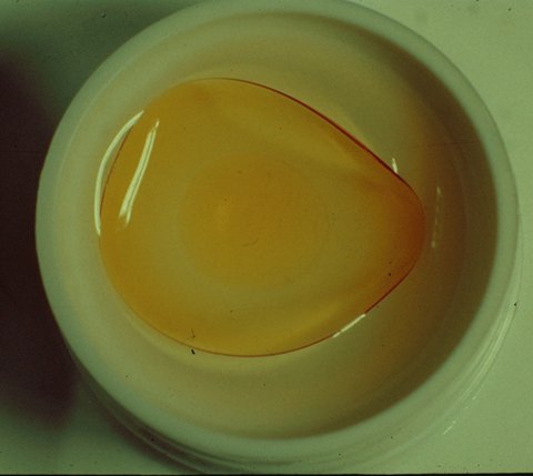 OptometricED's tweet image. A9: I will also advocate every day by educating my patient on their options and what is best for their health.  For example, this contact lens is from a smoker whose contact lens is discolored due to the nicotine and other chemicals on his fingers.  #educate.  #HPWChat