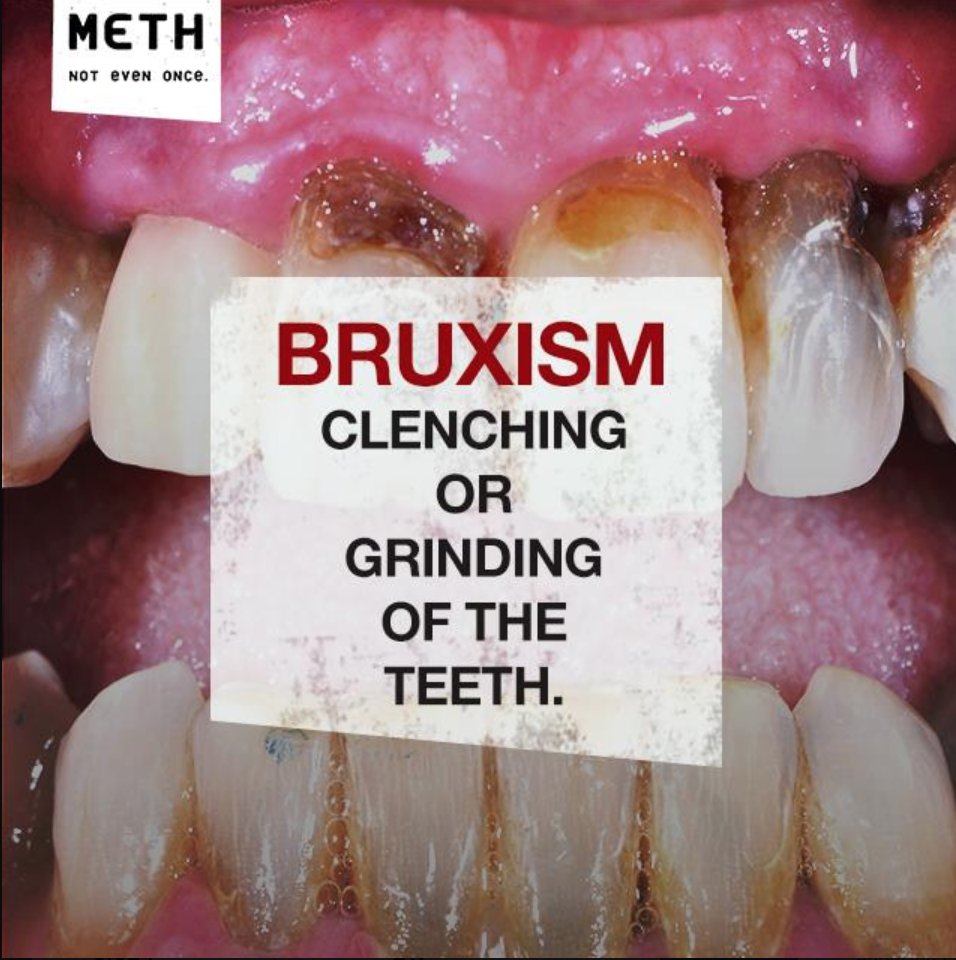 IDMethProject's tweet image. Methamphetamine can cause users to clench and grind their teeth resulting in tooth enamel erosion and cracked teeth. #NotEvenOnce