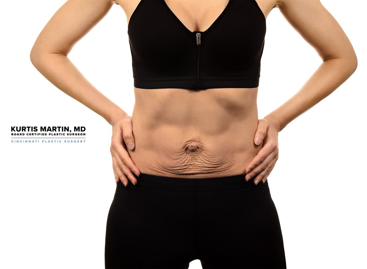 Лишний жир на животе. Обвисание кожи при похудении. Дряблая обвисшая кожа на животе. Упражнения для дряблого живота. Обвисшая кожа после похудения до и после.