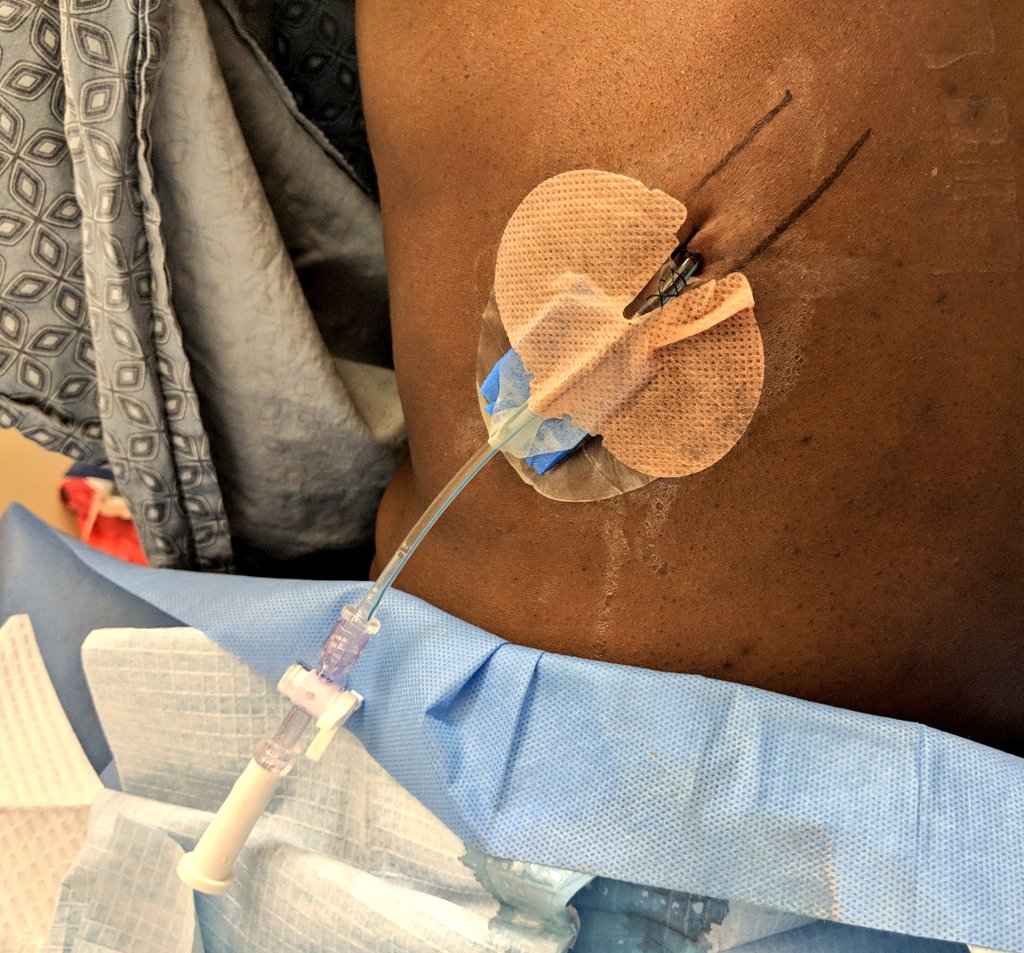 [THREAD] Our tips on small bore chest tube placement for pleural effusion! Performed by a resident  @BostonCityEM supervised by fellows  @BUPulmonary. We'd love your input! Not a comprehensive guide. Made with written patient authorization.  #meded  #FOAMcc  #pulmcc