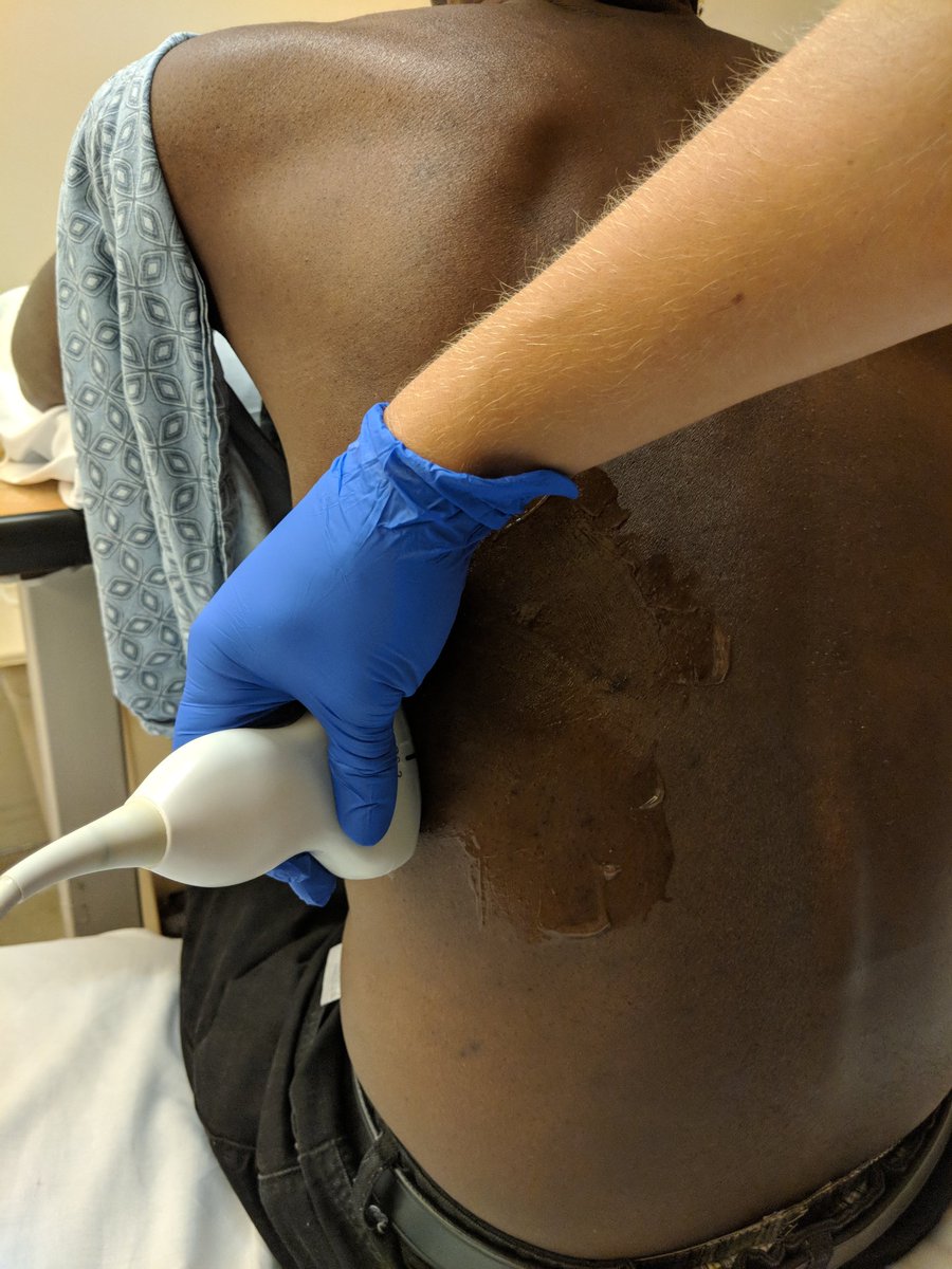 First step: ultrasound. We position the probe with marker to the head, as lateral as possible. Intercostals tend to sag as you move towards the midline, so you could hit them when going above the rib. Lateral access is safest.