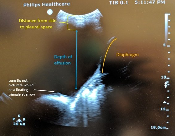 This is roughly what the US image should look like. Find the diaphragm and try to get a view where you see the collapsed lung floating in effusion (not pictured). Get a sense for the depth through body to effusion and depth of effusion to lung.  #pocus  #FOAMed