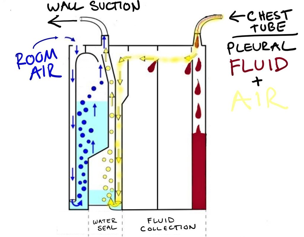 Next, hook the tube up to the box. We use  @AtriumMedical Oasis, a "dry" system with a water seal. Confusing! See diagram below, ask questions! FYI: clamp the system using the stopcock on the tube or using the sliding clamp over the drainage to the box.