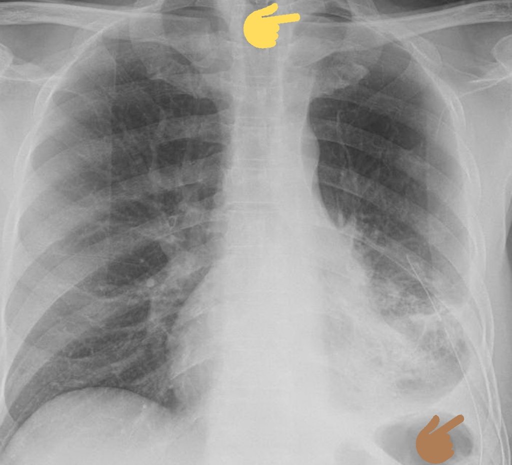 Watch water level closely, have pt take breaths/cough. Bubbles= air leaking out of pt, into tube. - flush tubes BID w/ stopcock- always get a CXR. Air in pleural space: entrained during placement or pneumothorax? Repeat film later to confirm resolution.Brown= tube, yellow= air