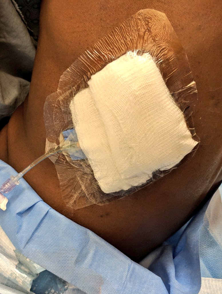 The dressing is critical. Use gauze to ensure a clean/dry site before attempting any dressing. A wet dressing is useless, and the dressing is what really holds the tube in place. We secure it to the front for patient comfort & use a few tegaderms to make it as secure as possible.