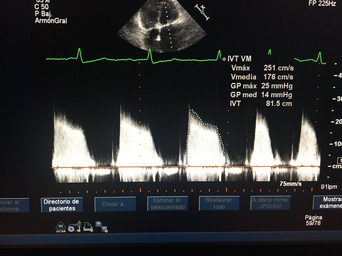 Rheumatic mitral stenosis and tricuspid regurgitation #echofirst #rheumaticdisease #3d