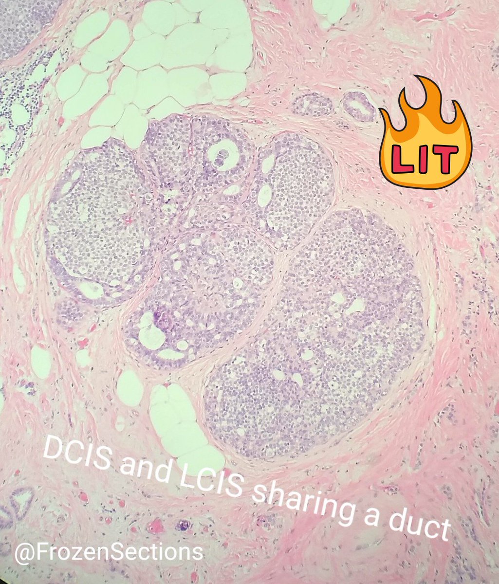 One man cannot serve two Masters? Well, here is a duct with both DCIS and LCIS 😎 Happy Pathology day!  #pathology #breastpath #pathologists #PathologyDay #BSTpath