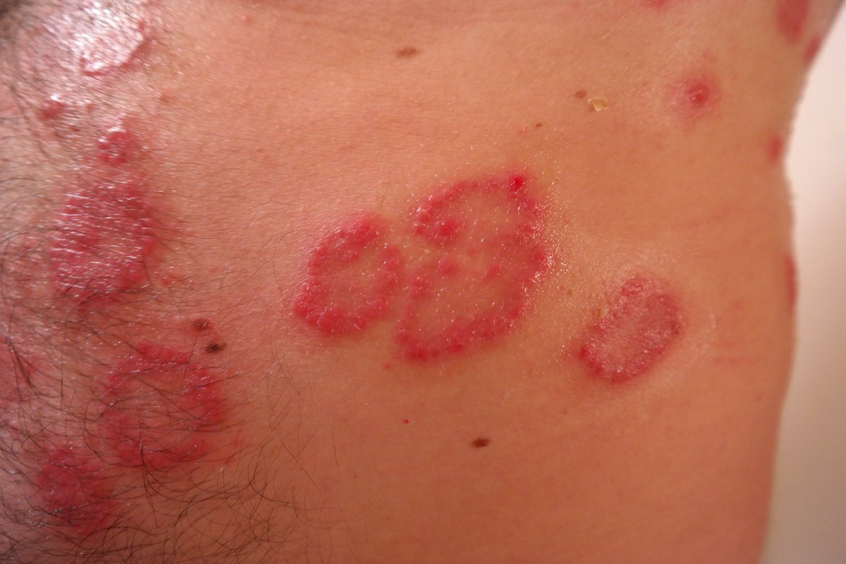 Comment traiter le psoriasis ? 
Les crèmes , #Photothérapie, #Biothérapie 

santemagazine.fr/traitement/med…

#Dermatologie #Dermatologue #Psoriasis #ProblèmedePeau #PlaquesRouges