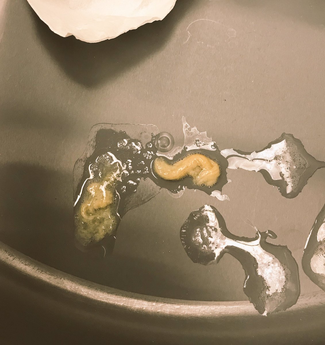 fjaffer88's tweet photo. Another early case of #plasticbronchitis this morning in a 50 years-old M with asthma. This one needs a little more work up as for precipitant cause but none the less, second case this year of what I thought was relatively rare in the adult population. #MedTwitter #PulmDocs https://t.co/RuV3Uqbs94